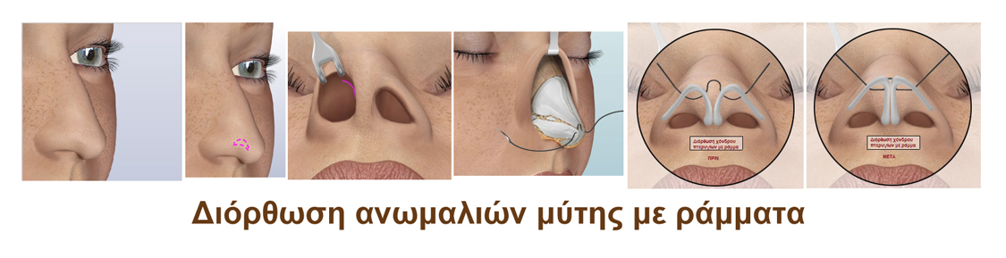 ρινοπλαστικη με ραμματα